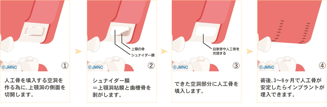 サイナスリフト法