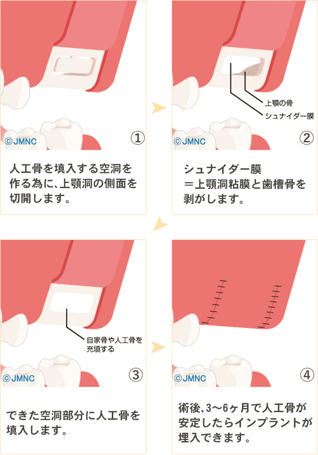 サイナスリフト法