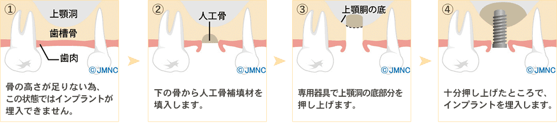 ソケットリフト法