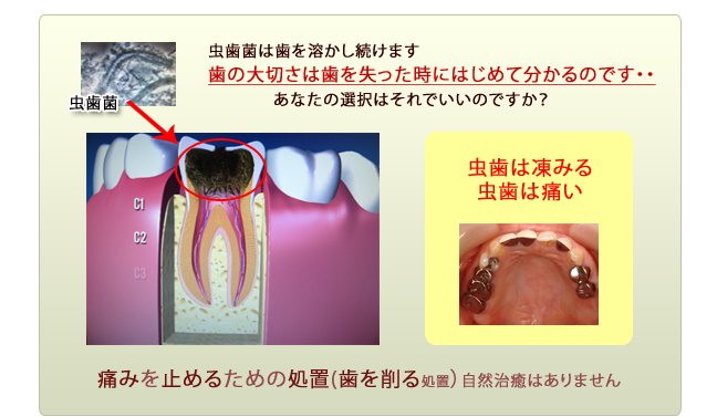虫歯治療２