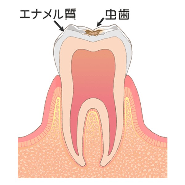 歯の表層（エナメル質）の虫歯