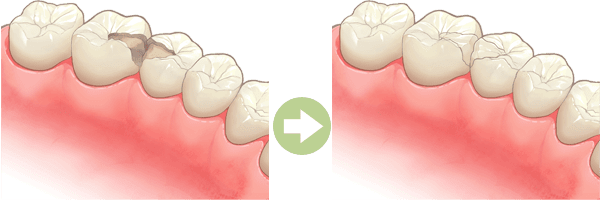 インレー（詰め物）