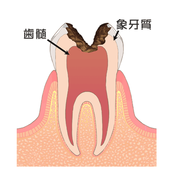 神経まで達した虫歯