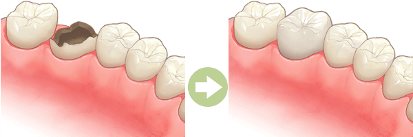 クラウン（被せ物）