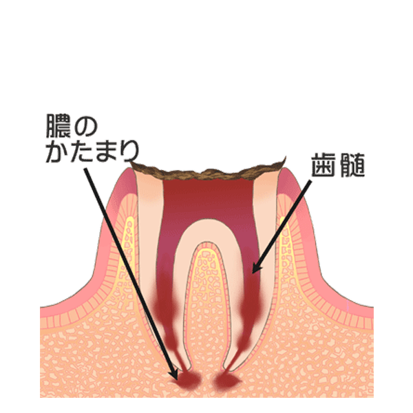 歯の根まで達した虫歯